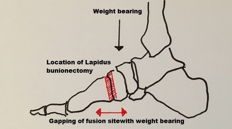 Lapidus bunionectomy